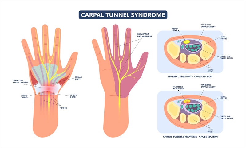 Síndrome del túnel carpiano