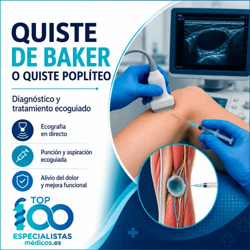 Aspiración ecoguiada de un quiste de Baker mediante control ecográfico