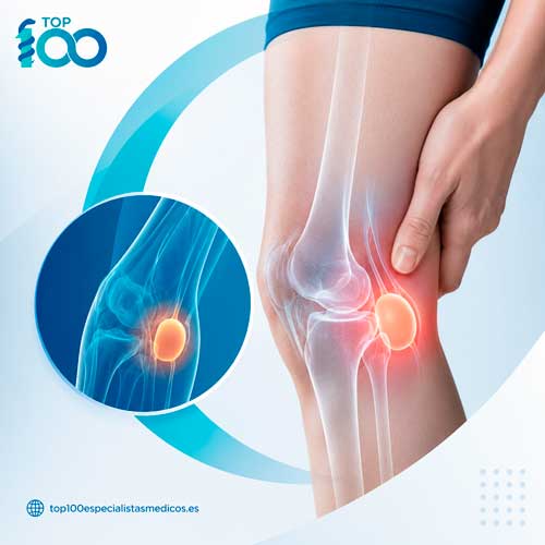 Acumulación de líquido sinovial en un quiste de Baker detrás de la rodilla